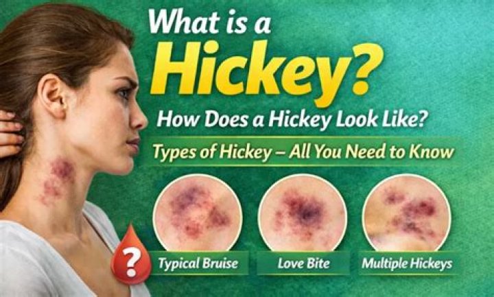 Are Hickeys Permanent? Unveiling the Truth About Love Bites