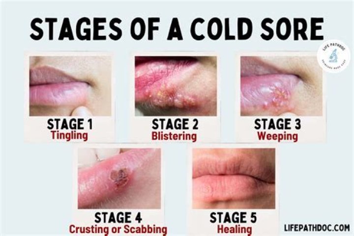 Cold Sores: Should I Pop the Blister? A Comprehensive Guide to Understanding and Managing Cold Sores