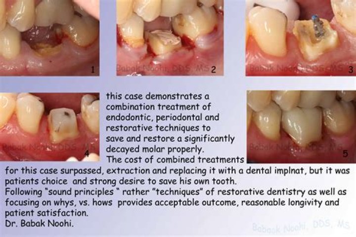 Tooth Crown Surgery: Everything You Need to Know for a Healthy Smile