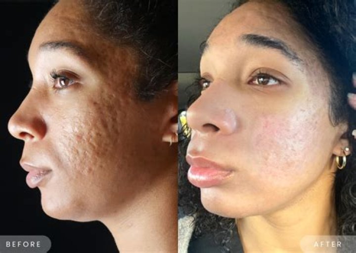 Tulsi Gabbard's Face: Acne Scars & More - What's the Buzz?